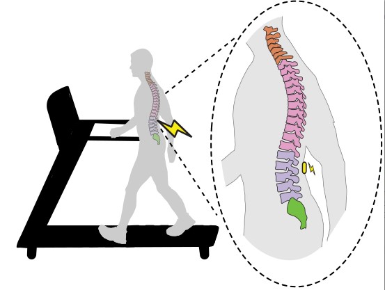 Spinal Stim Image