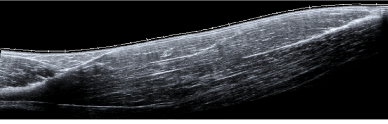  Motor  Impairment  Related Changes in Muscles Properties in 