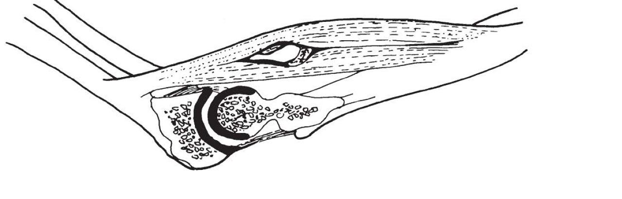 illustration of heterotopic ossification