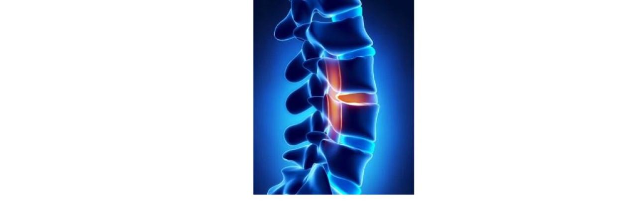 a graphic of a spine in blue shades with a few vertebrae in red