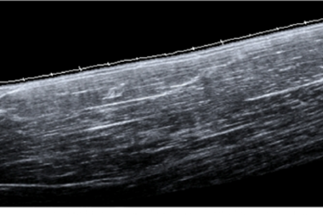 Extended field of view image of the biceps brachia
