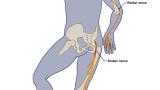 COVID nerve injury map