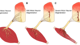 Conceptual framework for considering the status of lower motor neuron degeneration affecting key arm muscles that may be re-animated after spinal cord injury via nerve transfer surgery. In scenario C, which affects 30-40% of patients we screen, nerve transfer surgery should be avoided outside of the first 6 months post-injury due to detrimental impact of chronic muscle denervation on recipient muscle targets. However, reconstruction by tendon transfer may be considered.