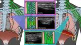 Types of Phrenic Neuropathy 